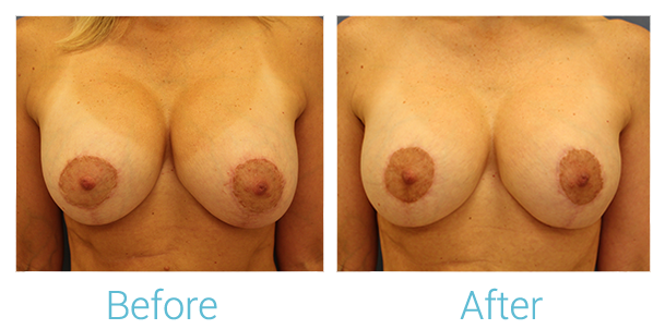 Breast Augmentation Before & After Gallery - Patient 58151847 - Image 1