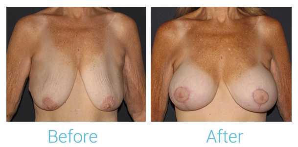 Breast Augmentation Before & After Gallery - Patient 58151850 - Image 1