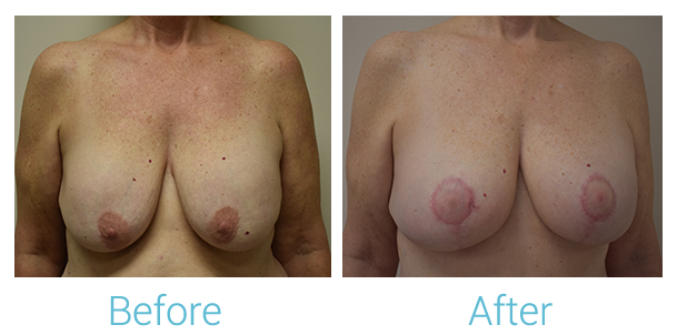 Breast Augmentation Before & After Gallery - Patient 58151851 - Image 1