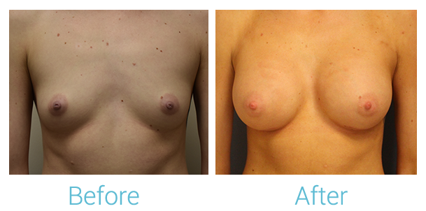 Breast Augmentation Before & After Gallery - Patient 58151852 - Image 1