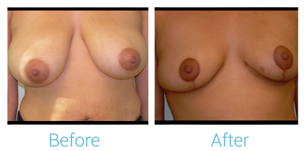 Breast Lift Before & After Gallery - Patient 58151880 - Image 1