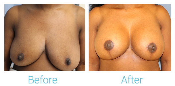 Breast Lift Before & After Gallery - Patient 58151884 - Image 1