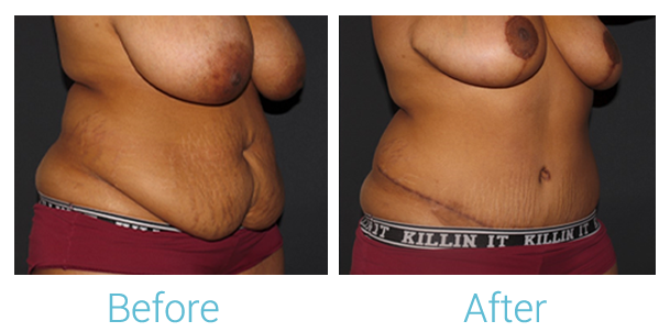 Mommy Makeover Before & After Gallery - Patient 58152030 - Image 2