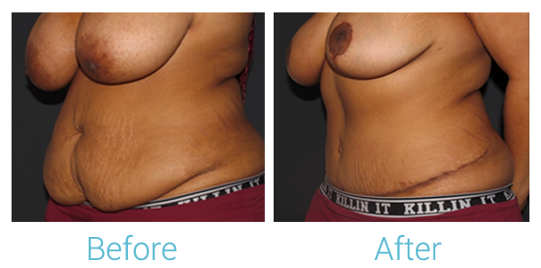Breast Reduction Before & After Gallery - Patient 58151917 - Image 3