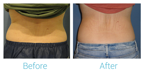CoolSculpting Before & After Gallery - Patient 58151951 - Image 3