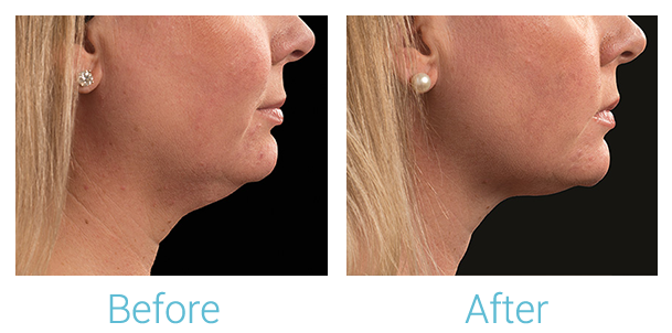 CoolSculpting Before & After Gallery - Patient 58151963 - Image 2