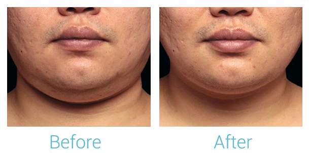 CoolSculpting Before & After Gallery - Patient 58151966 - Image 1