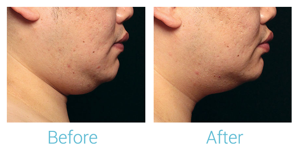 CoolSculpting Before & After Gallery - Patient 58151966 - Image 2