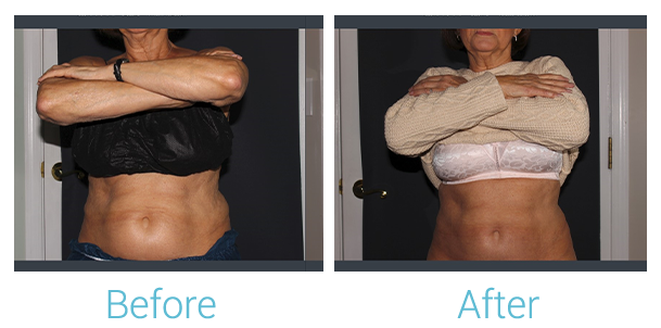 CoolSculpting Before & After Gallery - Patient 58152012 - Image 2