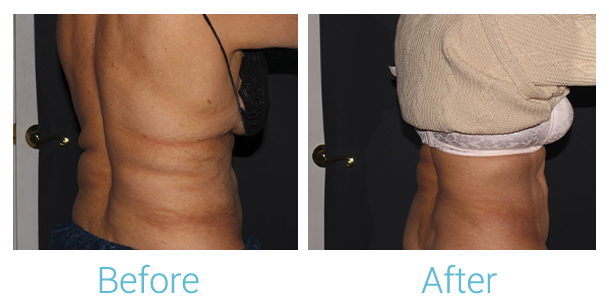 CoolSculpting Before & After Gallery - Patient 58152012 - Image 4