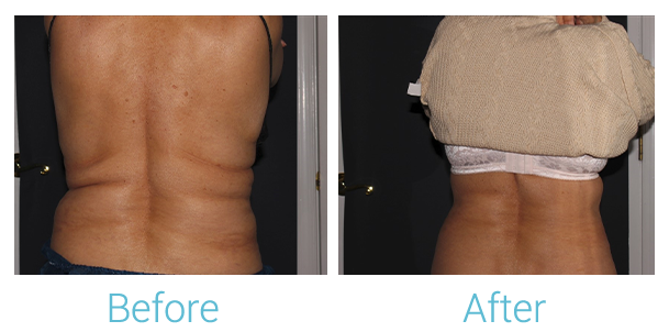 CoolSculpting Before & After Gallery - Patient 58152012 - Image 1