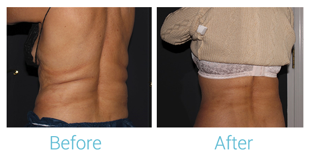 CoolSculpting Before & After Gallery - Patient 58152012 - Image 5