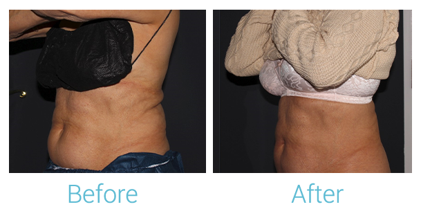 CoolSculpting Before & After Gallery - Patient 58152012 - Image 6