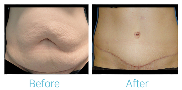 Tummy Tuck Before & After Gallery - Patient 58152052 - Image 1