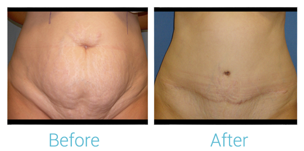 Tummy Tuck Before & After Gallery - Patient 58152053 - Image 1