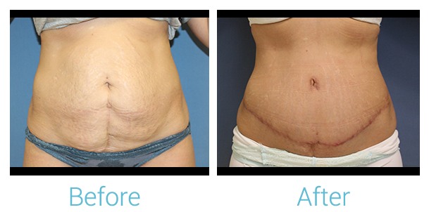 Tummy Tuck Before & After Gallery - Patient 58152084 - Image 1