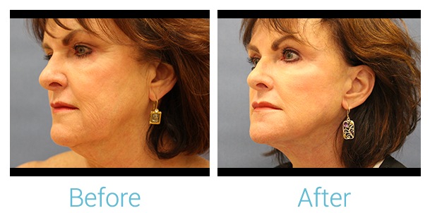 Facelift Before & After Gallery - Patient 58152101 - Image 2