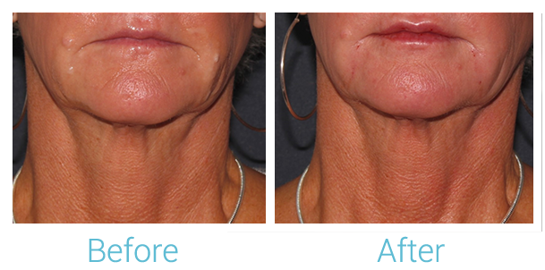 Fillers Before & After Gallery - Patient 58152120 - Image 1