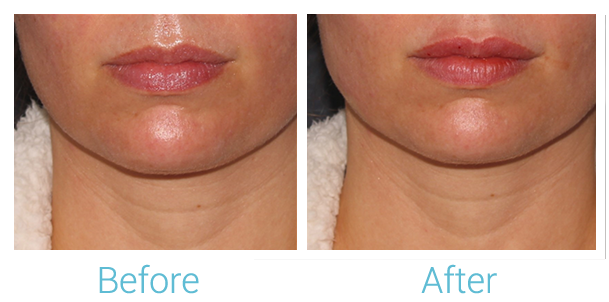 Fillers Before & After Gallery - Patient 58152121 - Image 1