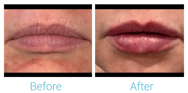 Fillers Before & After Gallery - Patient 58152122 - Image 1