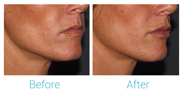 Fillers Before & After Gallery - Patient 58152126 - Image 2