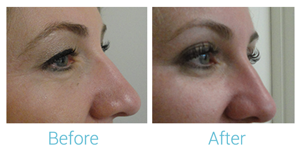 Ultherapy Before & After Gallery - Patient 58152132 - Image 2