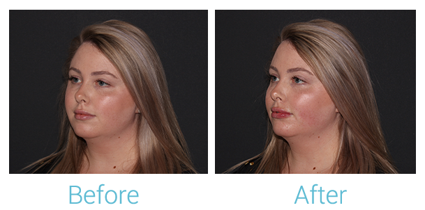 Fillers Before & After Gallery - Patient 154108521 - Image 2