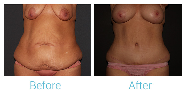 Tummy Tuck Before & After Gallery - Patient 141444567 - Image 1