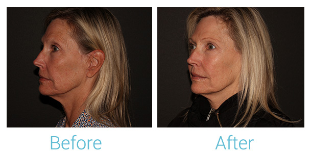Fillers Before & After Gallery - Patient 184933301 - Image 2