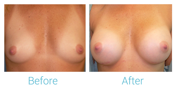 Breast Augmentation Before & After Gallery - Patient 58151782 - Image 1