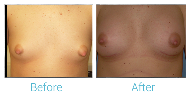 Breast Augmentation Before & After Gallery - Patient 58151784 - Image 1