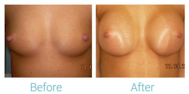 Breast Augmentation Before & After Gallery - Patient 58151794 - Image 1