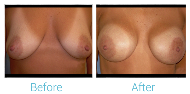 Breast Augmentation Before & After Gallery - Patient 58151796 - Image 1