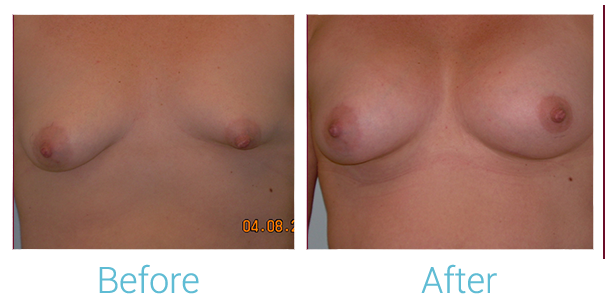 Breast Augmentation Before & After Gallery - Patient 58151797 - Image 1