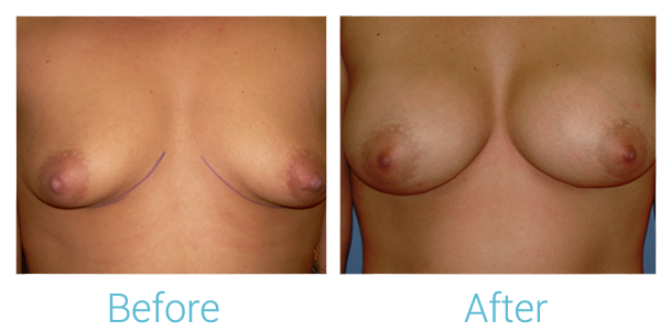 Breast Augmentation Before & After Gallery - Patient 58151798 - Image 1