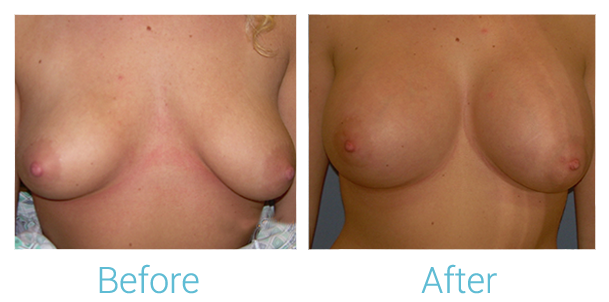 Breast Augmentation Before & After Gallery - Patient 58151801 - Image 1