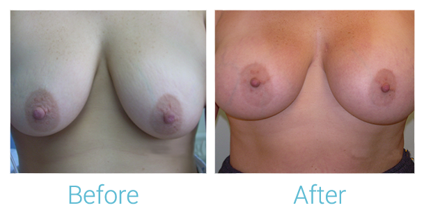 Breast Augmentation Before & After Gallery - Patient 58151810 - Image 1