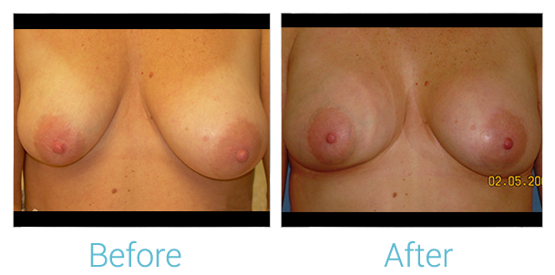 Breast Augmentation Before & After Gallery - Patient 58151812 - Image 1