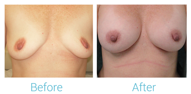 Breast Augmentation Before & After Gallery - Patient 58151813 - Image 1