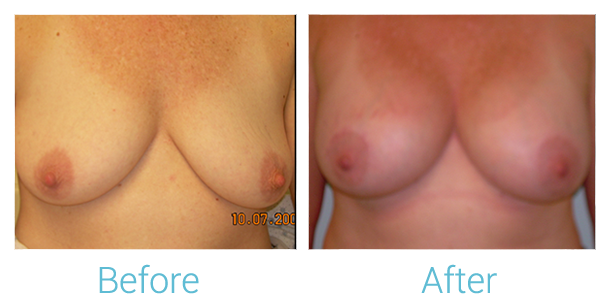 Breast Augmentation Before & After Gallery - Patient 58151814 - Image 1