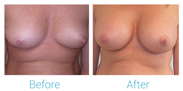 Breast Augmentation Before & After Gallery - Patient 58151840 - Image 1