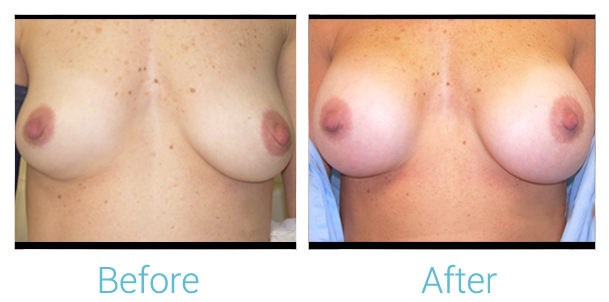 Breast Augmentation Before & After Gallery - Patient 58151841 - Image 1