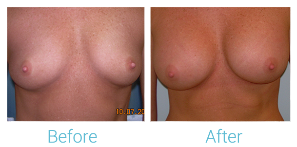 Breast Augmentation Before & After Gallery - Patient 58151842 - Image 1