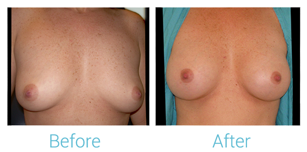 Breast Augmentation Before & After Gallery - Patient 58151843 - Image 1