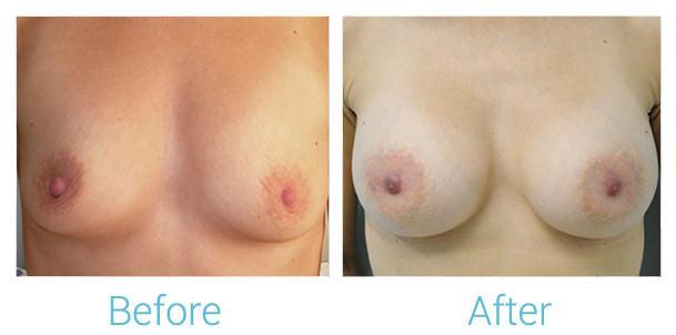 Breast Augmentation Before & After Gallery - Patient 58151844 - Image 1