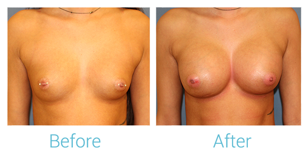 Breast Augmentation Before & After Gallery - Patient 58151845 - Image 1