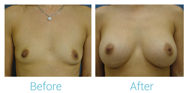 Breast Augmentation Before & After Gallery - Patient 58151846 - Image 1