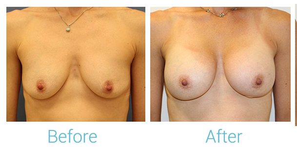 Breast Augmentation Before & After Gallery - Patient 58151854 - Image 1