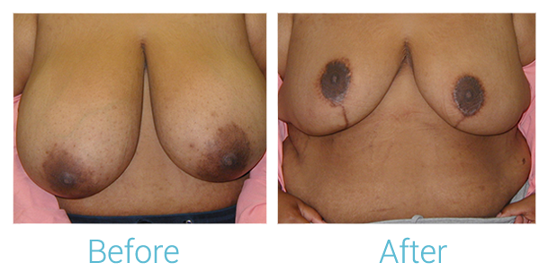 Breast Lift Before & After Gallery - Patient 58151873 - Image 1