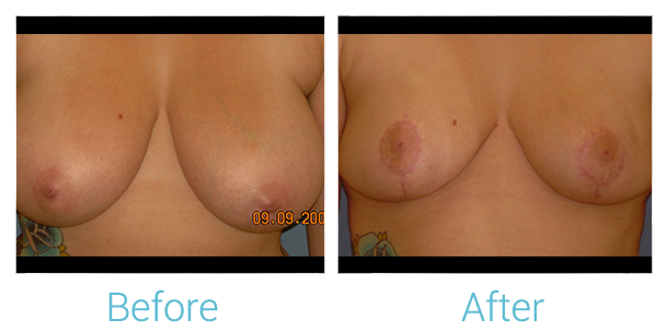 Breast Lift Before & After Gallery - Patient 58151879 - Image 1